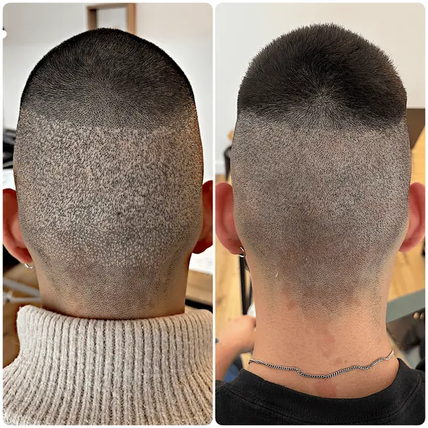 Technique micropigmentation — micro-points