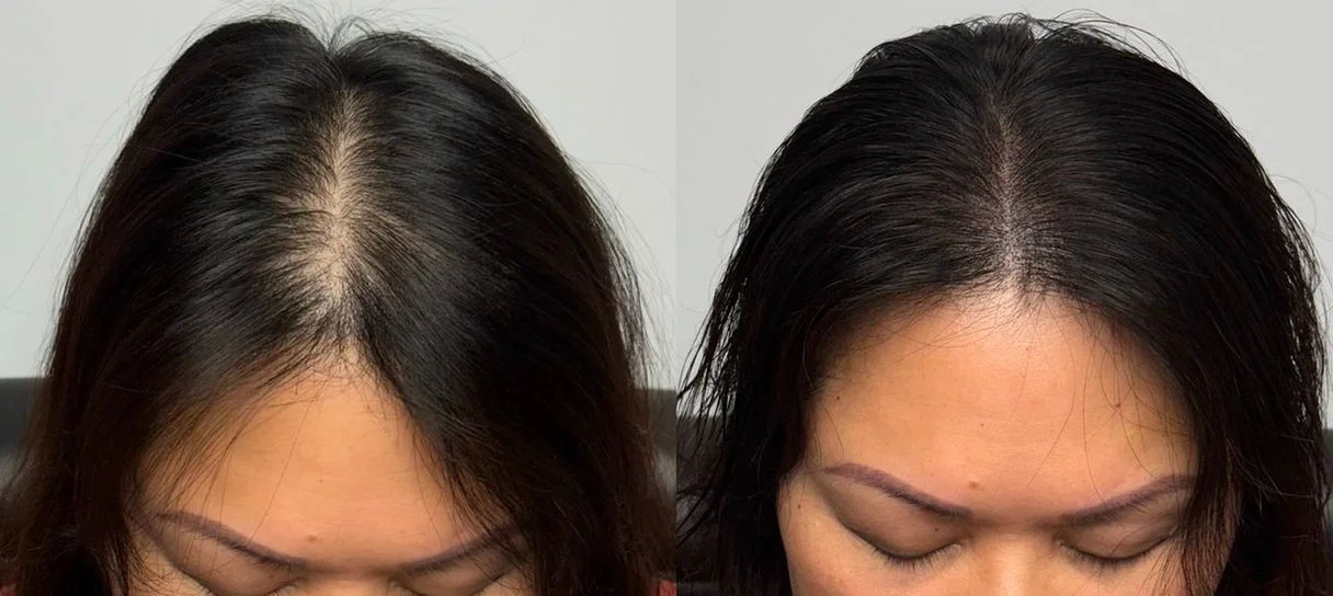 Résultat micropigmentation — pelade femme