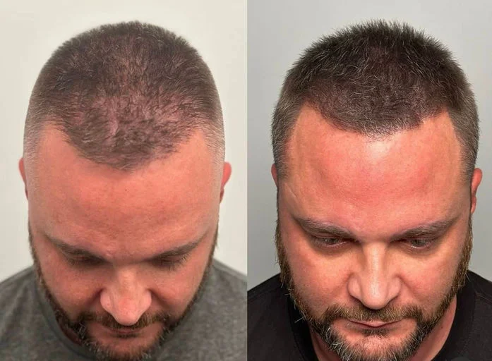 Cheveux clairsemés homme